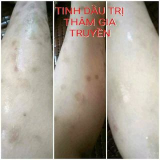 trị thâm gia truyền
