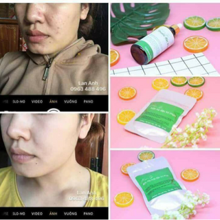 bộ trị mụn Huyền Phi