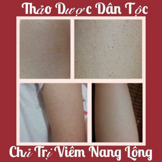 cam kết khỏi hoàn toàn viêm chân lông