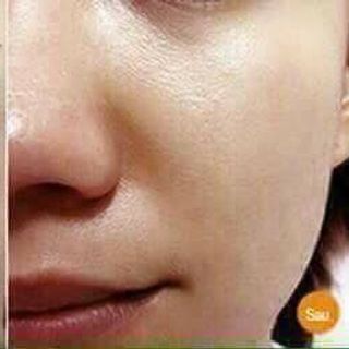 TINH DẦU TRỊ THÂM LINH HƯƠNG