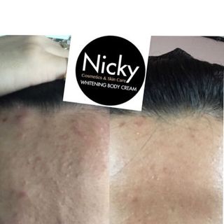 kem trị mụn Nicky Anties Acne