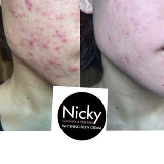 kem trị mụn Nicky Anties Acne