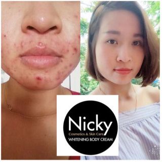 kem trị mụn Nicky Anties Acne