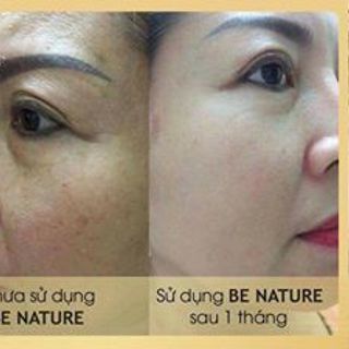 serum trị nám