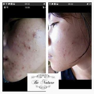 serum trị mụn