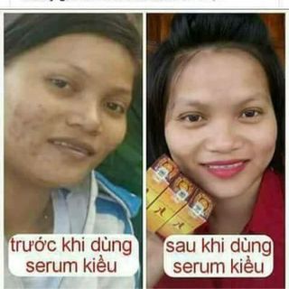 Serum Kiều Beauty Queen