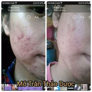 mỡ trăn thảo dược