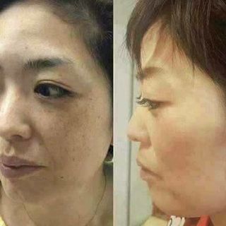 Kem đặc trị nám tàn nhang