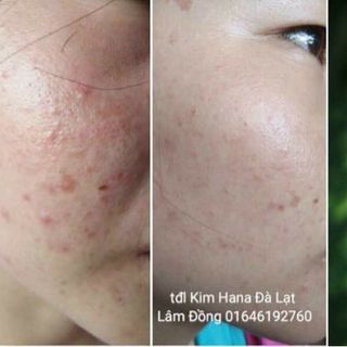 KEM TRỊ MỤN ASHI