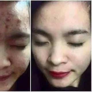 Thuốc Đặc Trị Mụn Huyền Cò - Special Acne Cream