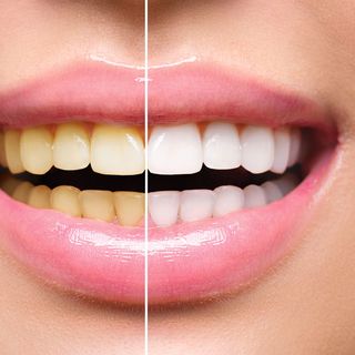Liệu trình trắng răng 20 ngày - 40 miếng dành cho răng ngã vàng