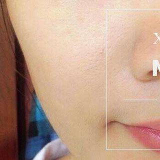 trị mụn đông y CUNG ĐÌNH HUẾ