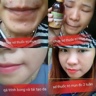 Thuốc đặc trị mụn trứng cá Lê Xuân