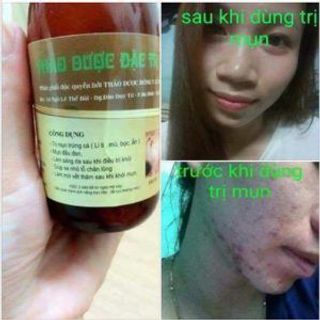 Thuốc đặc trị mụn trứng cá Lê Xuân