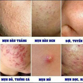 Thuốc đặc trị mụn trứng cá Lê Xuân