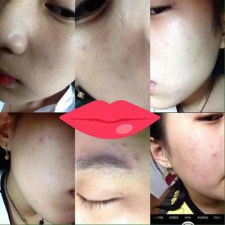 KEM TRỊ MỤN ASHI ACNES