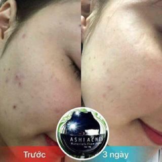 KEM TRỊ MỤN ASHI ACNES