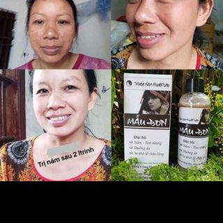 đặc trị nám từ thảo dược