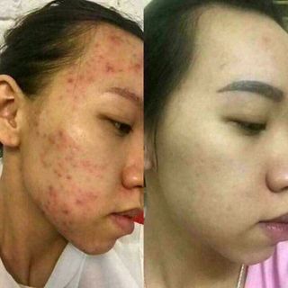 mỡ trăn thảo dược