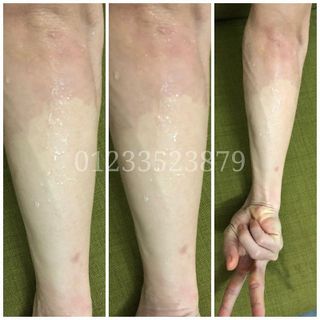 HẤP TRẮNG SIÊU CẤP
