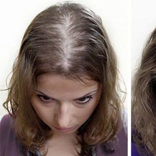 Xịt kích mọc tóc hỗ trợ trị hói Eksiderm của Nga