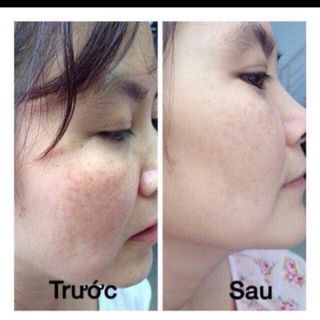 tam thao duoc đông y va trầu trị nám hết trong vong 20 ngày