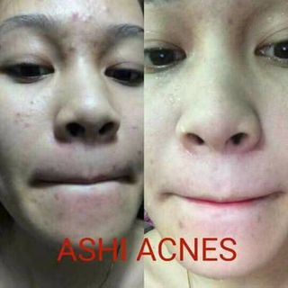 KEM TRỊ MỤN - THÂM ASHI