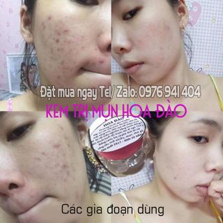 Kem trị mụn hoa đào- Trị mụn dưỡng da