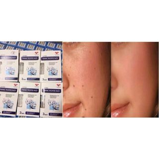 Gel trị nốt ruồi tàn nhang mụn thịt Nga
