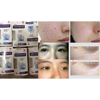 Gel trị nốt ruồi tàn nhang mụn thịt Nga