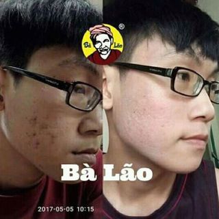 Nam Dược Trị Mụn Bà Lão