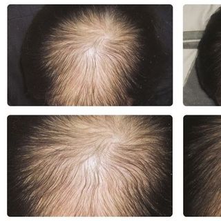 Tinh chất mọc tóc