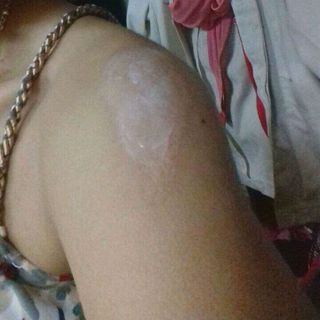 Kem Đặc trị sẹo