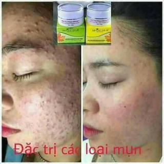 Bộ trụ mụn đông y