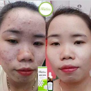 SERUM TRỊ MỤN