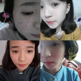 trị mụn gia truyền VânMOON