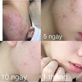 trị mụn gia truyền VânMOON
