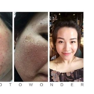 trị mụn gia truyền VânMOON