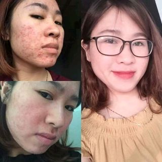 trị mụn gia truyền VânMOON