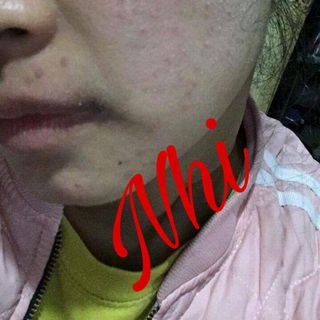 trị mụn thâm nám tàn nhan lâu năm