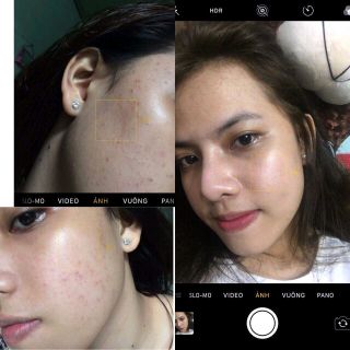 trị mụn thâm nám tàn nhan lâu năm