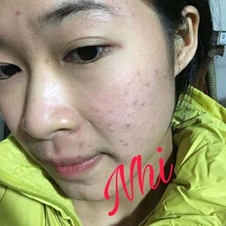trị mụn thâm nám tàn nhan lâu năm