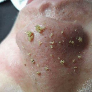 Ủ Mụn