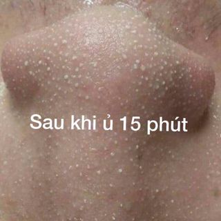 Ủ MỤN THẦN THÁNH OHIO