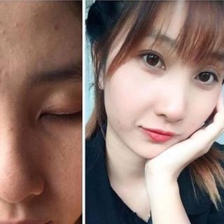 THẢO DƯỢC THIÊN NHIÊN TÁI TẠO DA HOA MỘC LAN