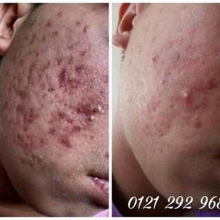 Thuốc Đông Y Trị Mụn Dương Quý Phi