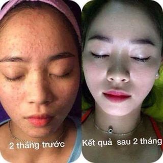Bộ Trị Mụn Đông Y Ngọc Sâm