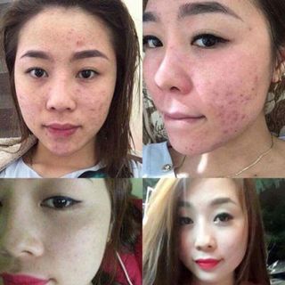 Bộ Trị Mụn Đông Y Ngọc Sâm