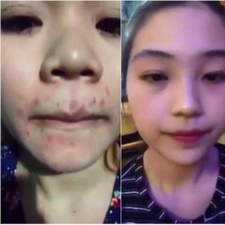 Bộ Trị Mụn Đông Y Ngọc Sâm
