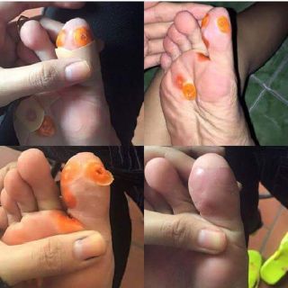Miếng dán trị mụn cóc mắt cá chân Plasters